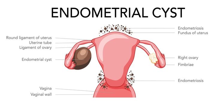 Set of Ovarian endometriomas chocolate cysts Female reproductive system uterus problem diagram with inscriptions