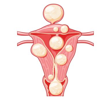 Set of Uterine fibroids Female leiomyomas reproductive system uterus in different styles and cross sections. Front view