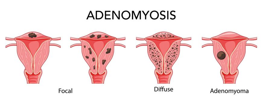 Adenomyosis illness set - focal, diffuse and adenomyoma Female reproductive system, organs. Human anatomy location