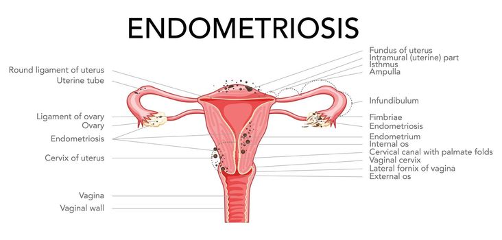 Endometriosis stages Female reproductive system pain uterus diagram with inscriptions text. Front view. Human anatomy