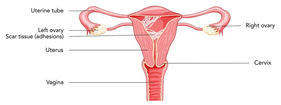 Asherman syndrome Female reproductive system scar tissue adhesions in uterus diagram with inscriptions. Front view