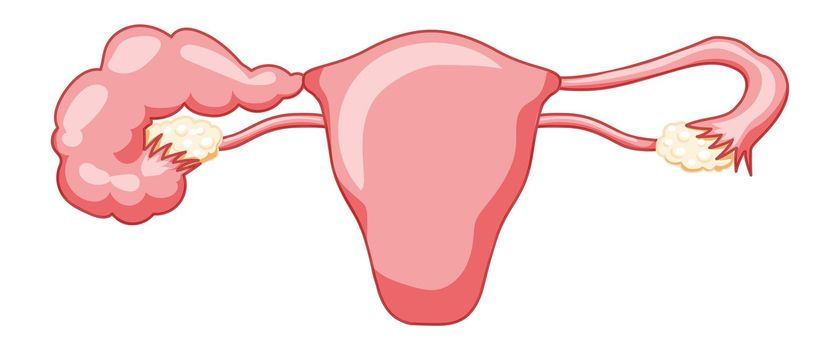 Hydrosalpinx Female reproductive system blocked fallopian tube uterus with description text. Human anatomy organs