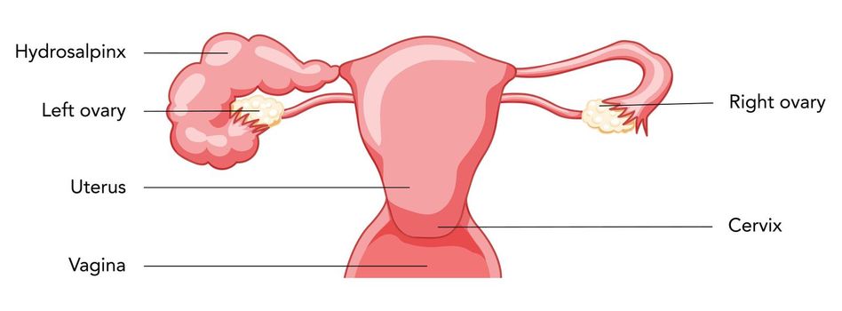Hydrosalpinx Female reproductive system blocked fallopian tube uterus with description. Human anatomy internal organs