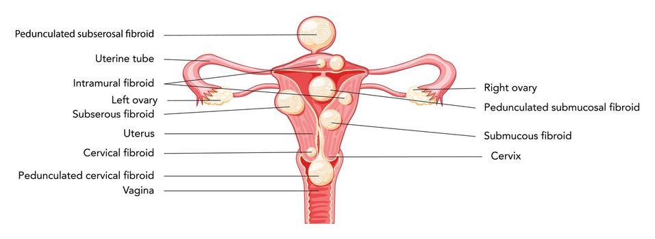 Uterine fibroids Female leiomyomas reproductive system uterus diagram with inscriptions in Latin text. Human anatomy