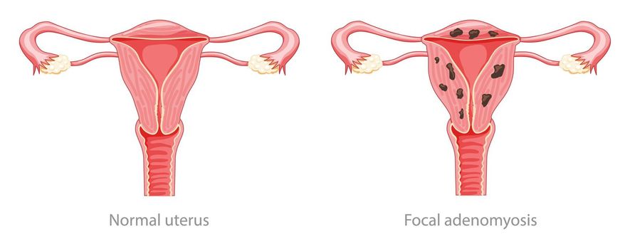 Adenomyosis Focal Human anatomy Female Sick and normal reproductive system organs. Location scheme Cross section uterus