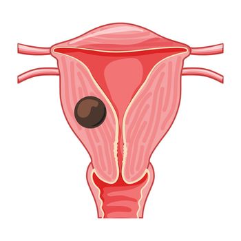 Adenomyoma Human anatomy Female reproductive Sick system, organs. Adenomyosis scheme uterus, cervix, ovary, fallopian