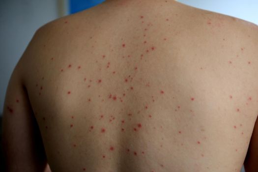 roseola infection