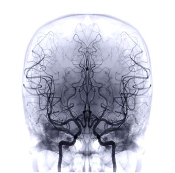Cerebral angiography  