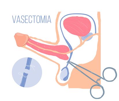 Male reproductive system. Illustration of male organ health, vasectomy and infertility