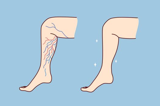 Close-up of unhealthy and healthy leg with varicose veins. Patient suffer from varicoses. Healthcare and medicine. Vector illustration.