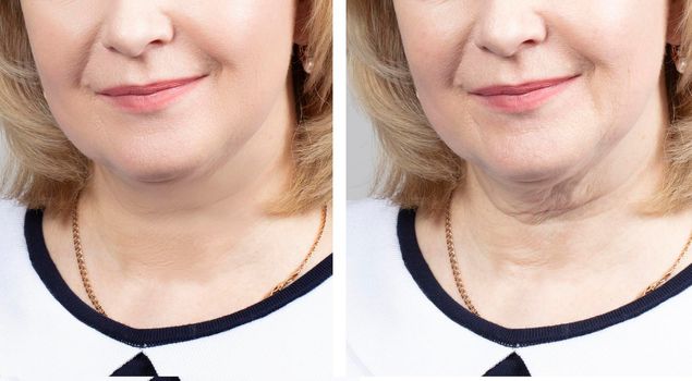 Part of the face of an elderly woman before and after cosmetic procedures.Elderly woman face wrinkles before and after procedures