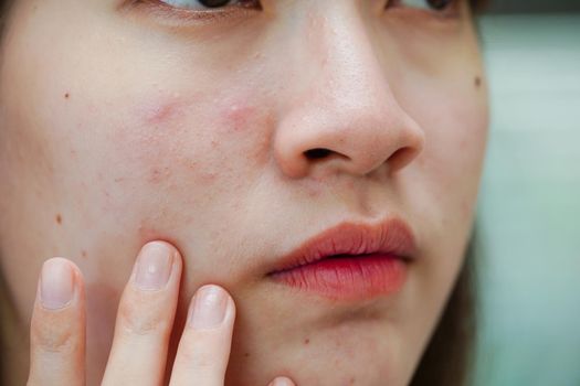 Acne pimple and scar on skin face, disorders of sebaceous glands, teenage girl skincare beauty problem.