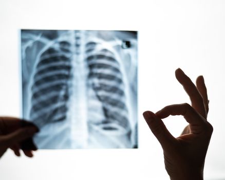 The doctor looks at the x-ray of the patient's lungs and shows the ok sign.