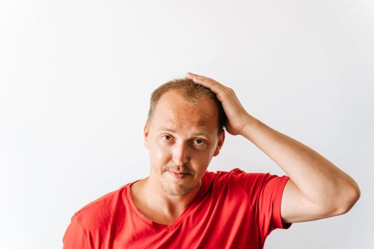 Before hair transplantation. Young bald man with hair loss problems holding his head