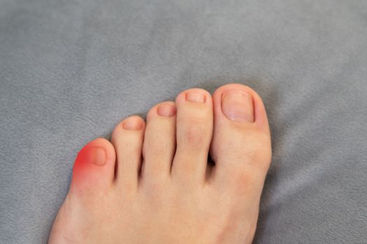 Inflammation on female foot with red spot. Concept of feet pain and disease