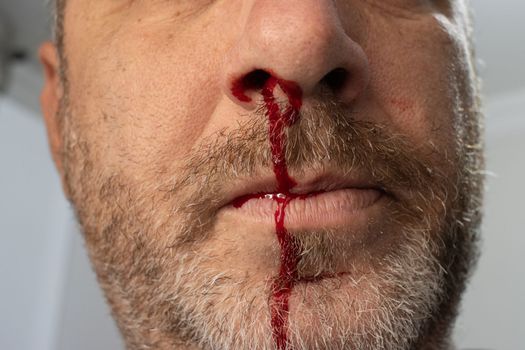 nosebleed , A man is bleeding from his nose