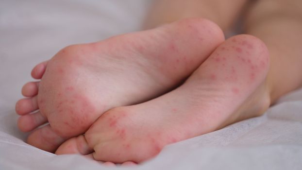 Eczema is an irritation caused by an allergic lesion of skin of feet in child