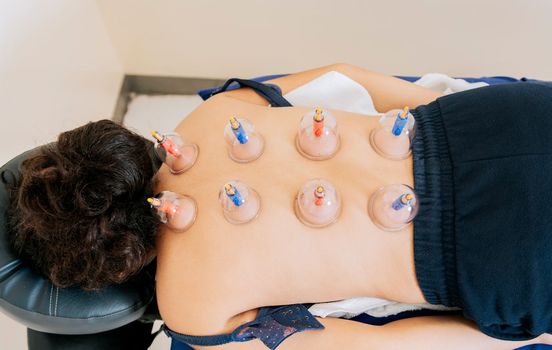 Patient lying down with suction cups on her back. Physiotherapy cupping on a lying patient. Close-up of suction cups on the patient back, Acupuncture cupping on the back of a person lying down