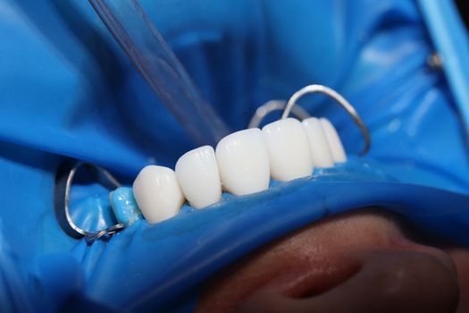 Teeth of patient with veneers being treated by dentist closeup. Dental treatment beautiful smile concept