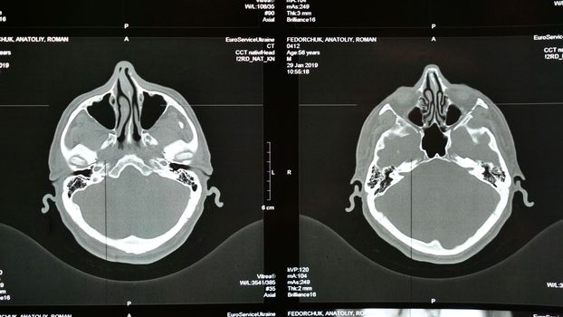 X-ray of the brain MRI in stroke