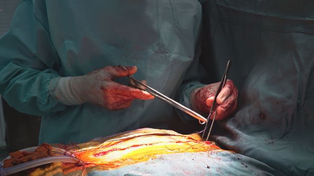 A valve replacement is performed in the operating room when a malfunctioning valve in the heart causes an open heart surgery