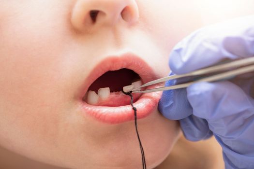 Extraction of a milk tooth in a child. Self-extraction of a tooth with a floss at home. Tie a floss to the tooth to extract it.