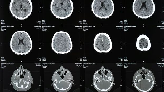Magnetic resonance imaging of the brain from different sides, traumatic brain injury in an 60 old male patient in the hospital, showing that the brain is affected. Examination by a neurologist