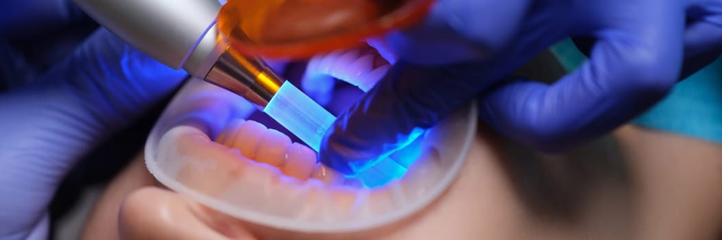 Doctor dentist illuminating filling with modern light lamp in clinic closeup