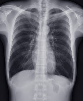Chest x-ray image for screening diagnosis TB,tuberculosis and covid-19.