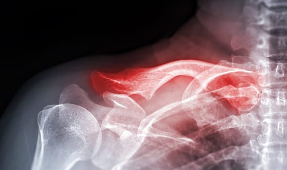 X-ray of Clavicle AP view for diagnosis fracture of Clavicle bone.