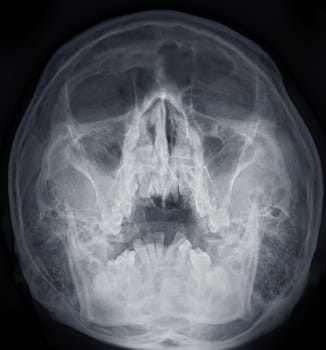 x-ray image of paranasal sinuses for diagnosis sinusitis.