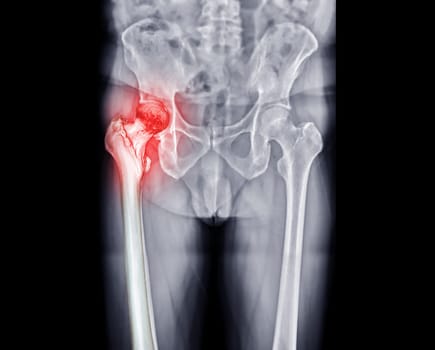 x-ray Both hip  ap view showing Right hip replacement or hip prosthesis made from titanium .
