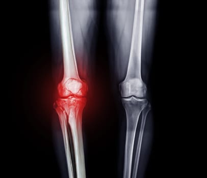 X-ray image of both knee AP view for diagnostic Osteoarthritis or knee fracrure.