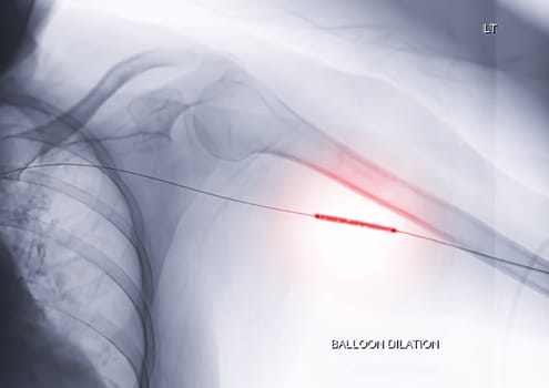 Angioplasty, balloon angioplasty and percutaneous transluminal angioplasty (PTA) on Left arm.