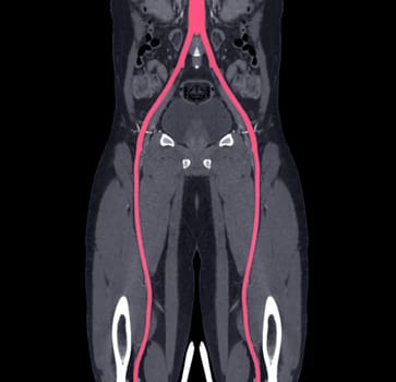 CTA femoral artery run off MPR curve .