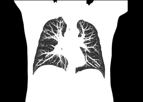 CT scan of Chest or lung at radiology department in hospital. Covid-19 scan body xray test detection for covid virus epidemic spread concept