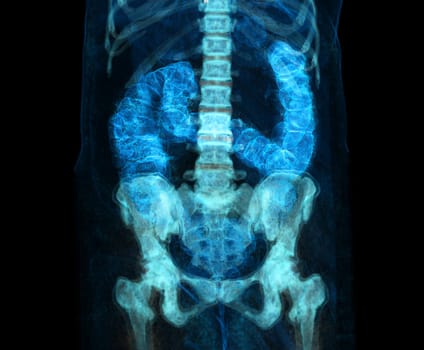 CT colonography or CT Scan of Colon 3D Rendering image for screening colorectal cancer. Check up Screening Colon Cancer.