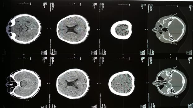 MRI of the brain of an older man