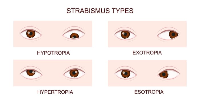 Strabismus types. Hypotropia, hypertropia, exotropia, esotropia. Human eyes with different squint disorders. Crossed eyes condition