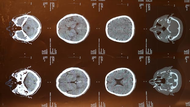 magnetic resonance imaging of the brain after a traumatic brain injury in an elderly male patient in the hospital, showing that the brain is affected, vertical