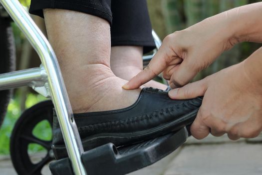 Elderly woman swollen feet press test on wheelchair