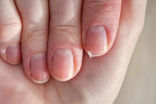 Close-up of brittle nails on woman's hands. Female broken fingernail.