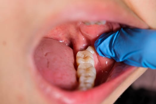 Wisdom teeth affect and cause gum recession.
