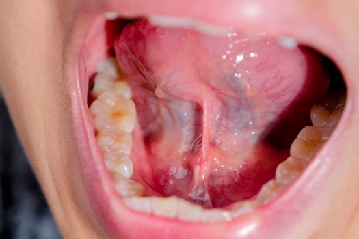Close-up of the lower jaw, hard palate, soft palate, teeth and gums of a middle-aged woman.