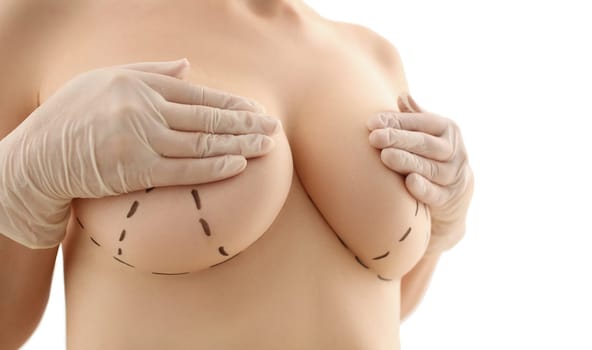 Woman shows surgical recommendations marked by surgeon for mastectomy or breast implant on naked female breast