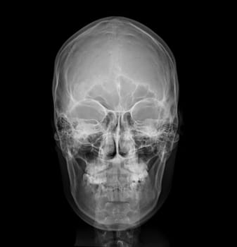 X-ray image of Human Skull Front view for diagnosis skull fracture isolated on Black Background.