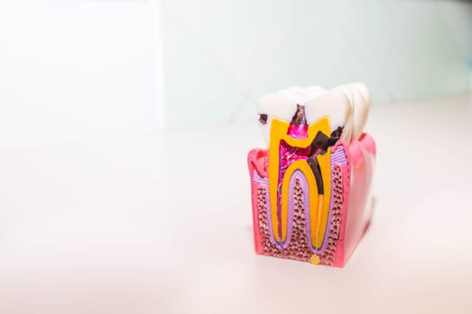 tooth model with caries, tooth decay in dentist's office. Healthy teeth concept . Big tooth model with details on the nerve, dentin, enamel, cavities and abscesses, dental diseases.Copy space