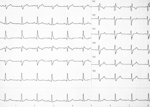 Heart rate on paper for recording an electrocardiogram, prevention of heart diseases. Electrocardiogram strips with cardiac arrhythmias. Alterations of heartbeats represented on paper. Copy space.