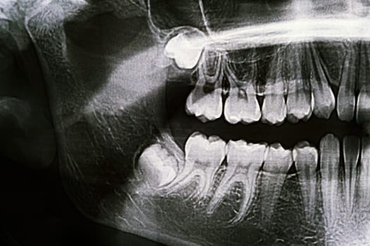 Panoramic X-ray of the jaw. X-ray of the teeth of a 12-year-old girl