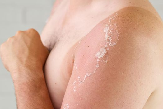 sunburned skin on a man's body. Skin care and UV protection concept
